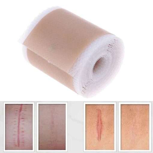 Scar Removal Silicone Gel Self-Adhesive Silicone Gel Tape Patch for Acne Burn Scar Reduce 1